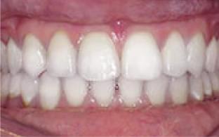 Invisalign