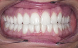 Invisalign