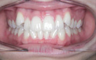 Invisalign