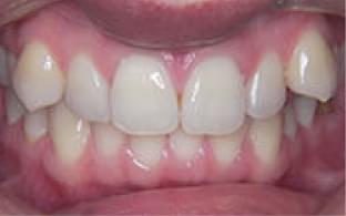 Invisalign