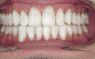 invisalign-after-03.jpg