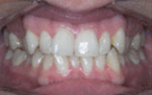 invisalign-after-04.jpg