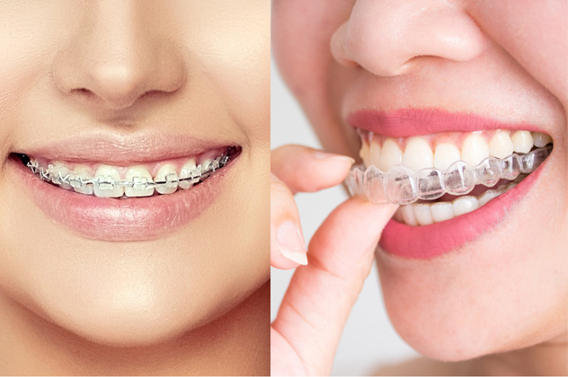 Still have questions about clear aligners or braces?