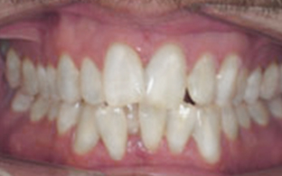 invisalign-after-03.jpg