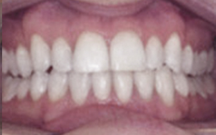 invisalign-after-04.jpg